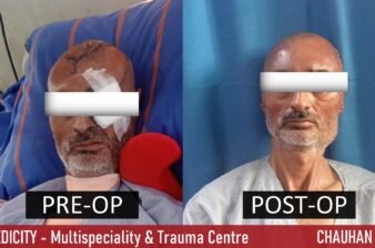 Customized 3D Mesh Cranioplasty in an operated case of Bifrontal Contusion and Depressed Fracture